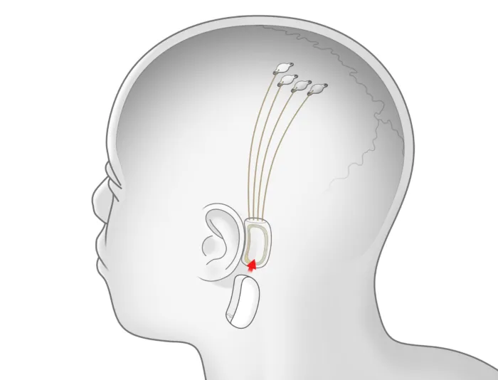 Neuralink, la société d’Elon Musk, recrute pour les premiers essais sur l’homme